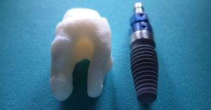 Dental Implants in Chennai
